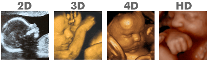 2d ultrasound, 3d ultrasound, 4d ultrasound and hd ultrasound comparison images